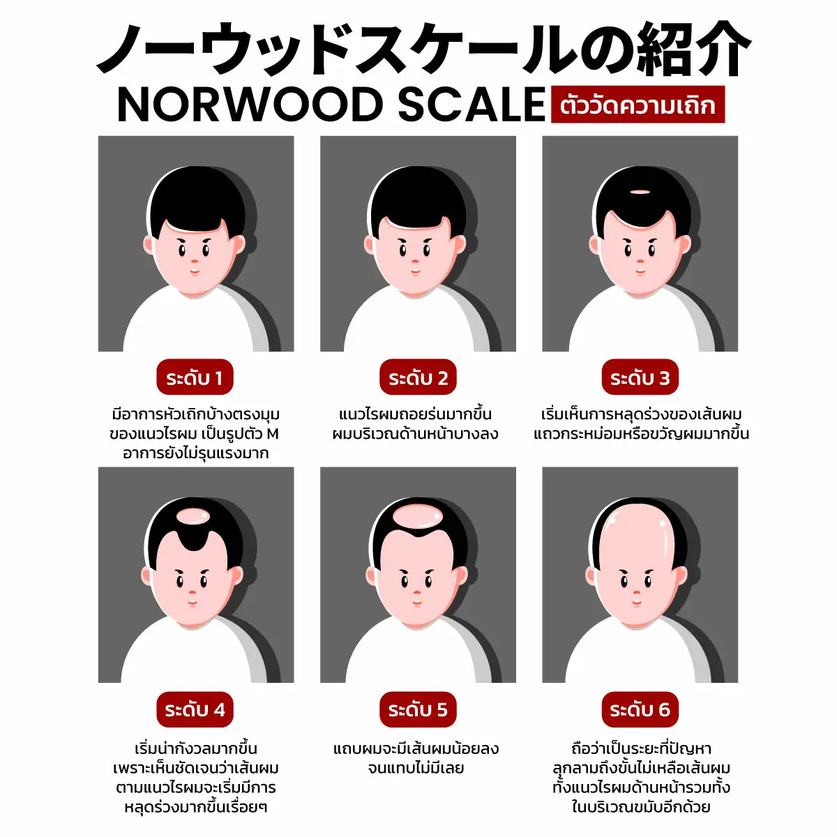 นี่เรา &lsquo;หัวล้าน&rsquo; ขนาดไหน ? มารู้จักกับ Norwood Scale กัน